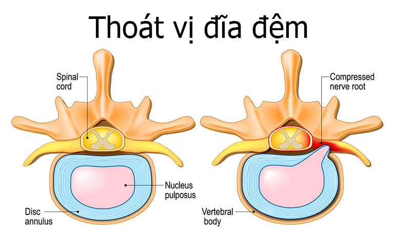 Phương pháp massage bấm huyệt cho người thoát vị đĩa đệm